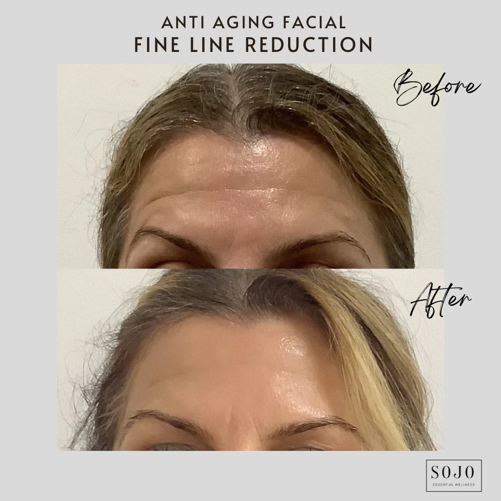 anti-aging-facials-skin-tightning